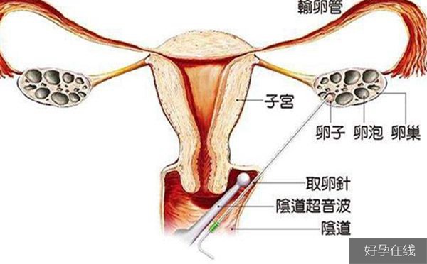 取卵手术费用