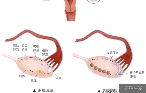 促排优势卵泡过多怎么办