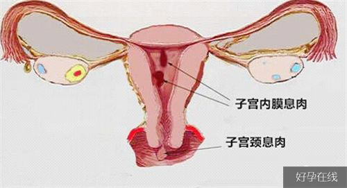 子宫内膜息肉2cm算大吗